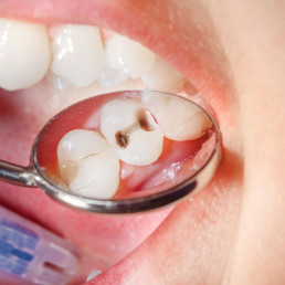 conservativa endodonzia bari